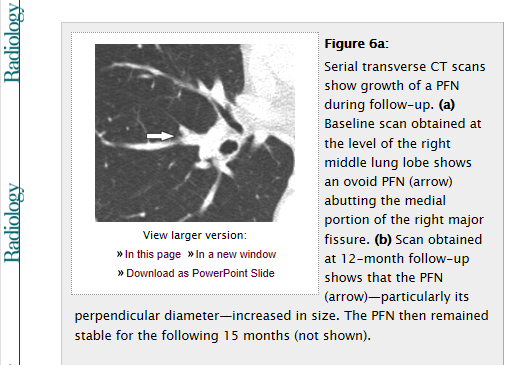 Pulmonale lymfeknuter kan