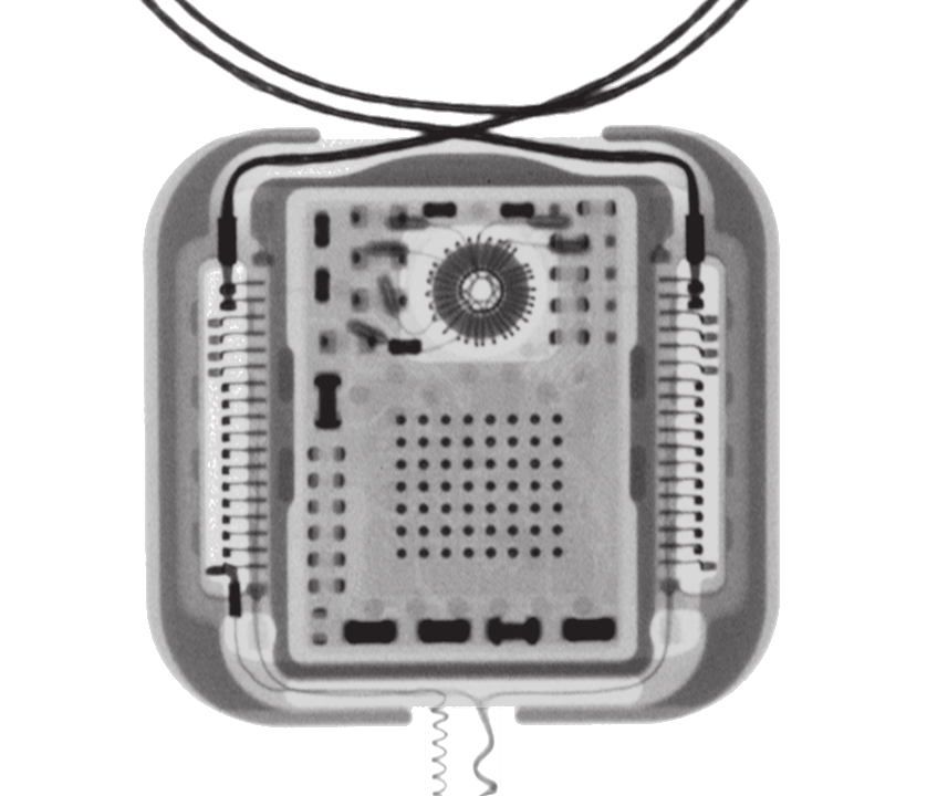 Cochlear Nucleus-cochleaimplantat i CI500-serien Om nødvendig kan implantattypen og -modellen identifiseres uten kirurgi ved hjelp av røntgen eller Cochlears programmeringsprogram.