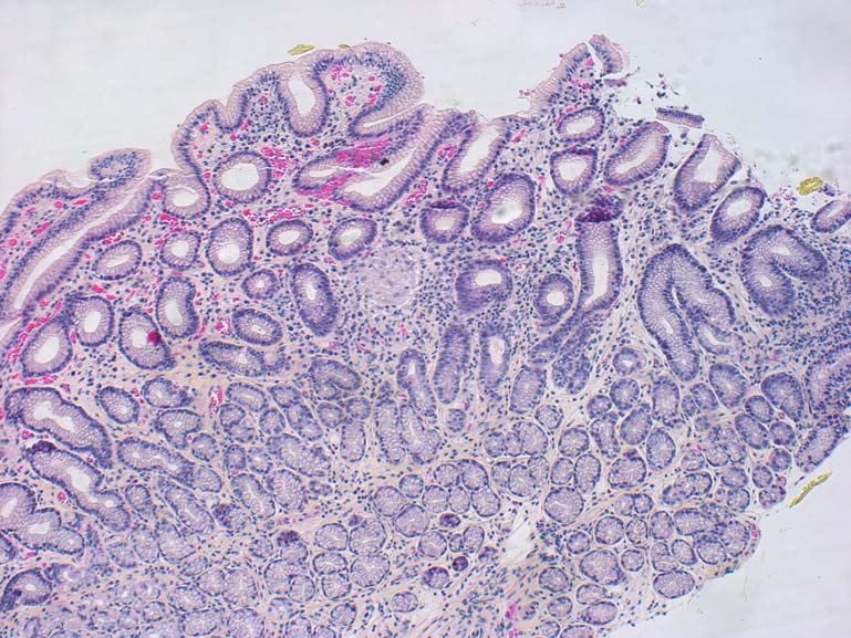 GRANULOMATØS BETENNELSE Crohns sykdom