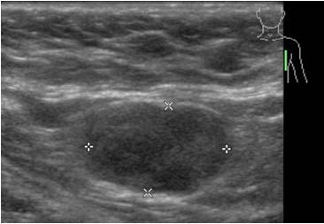 PET-CT undersøkelse Lav-dose spiral-ct helkropp < 1 min PET helkropp ca. 25 min = 6-8 x ca. 3 min CT for attenueringskorreksjon: sparer tid i forhold til tidligere PET-skannere evt.