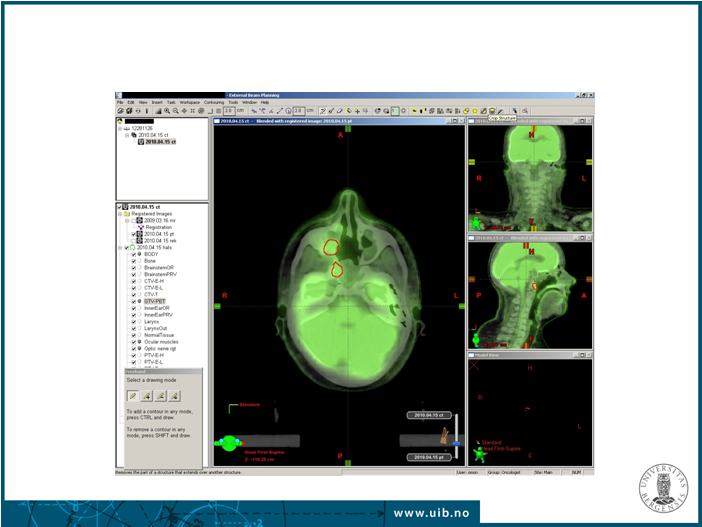 Ultralyd kv. 55 år PTC OP 2006 FNB: Papillær thyroideacancer! 400 x L. Helgeland HUS 25 FDG-PET ved residiv av ca. thyreoidea n = 27 pas. HUS 6/2009 1/2011 Ultralyd, I-131 SPECT-CT, FDG-PET inkl.