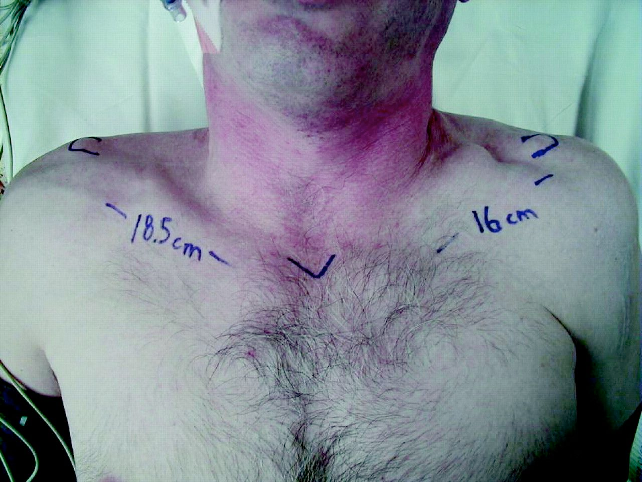 Clavicula fracturer - undersøkelse. Traumeanamnese. Palpasjonsfunn - åpen fractur? Truet hud?