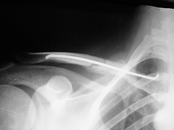 Clavicula fracturer - behandling. Tradisjonell konservativ behandling: Slynge, mammabandasje e.l. i 2 uker, deretter starte pendeløvelser.