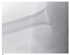 Proximale humerusfracturer: Utredning.