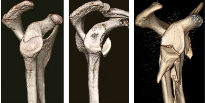 Scapulafracturer - behandling. Som oftest konservativt. Obs glenoid fracturer.