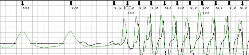 Figur 9. Kompresjonsartifakter i EKGet. Lett merke til tilnærmet flatt EKG i perioden med bare ventilasjoner, mens når man begynner å komprimere får man utslag i EKG-et også.