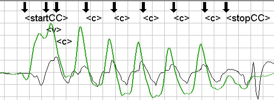 kompleks i EKG-signalet. Man vil i disse periodene kun se utslag i impedansesignalet svarende til ventilasjoner utover den nevnte 'dip'; event.