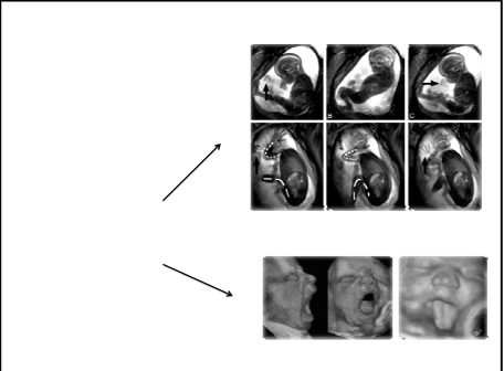 Pseudosinusoidal- normal CTG det skal være perioder med normal CTG!