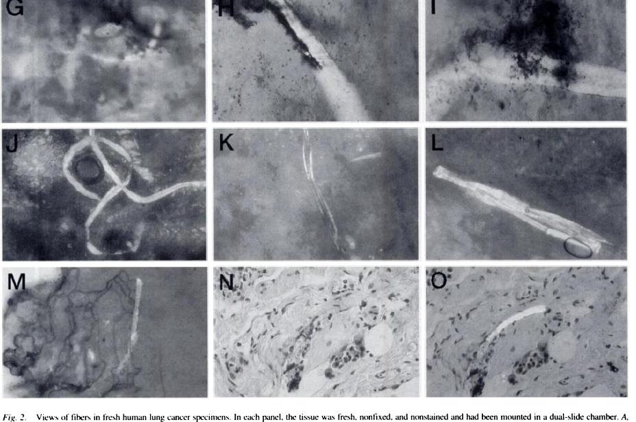 Bilder av støvfibre funnet i kreftvev i menneskelunger bl.a. plast, asbest og cellulose Pauly et al.