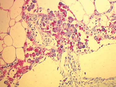 123 Figur 3.5.3.3 Immunhistokjemi ved IPN, hvor virus merkes med rød farge.