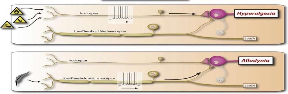 Sentral sensitivisering an amplification of neural signaling within the CNS that elicits pain hypersensitivity Woolf (2011) Intens smertesignalisering forandrer sentrale nevron LTP