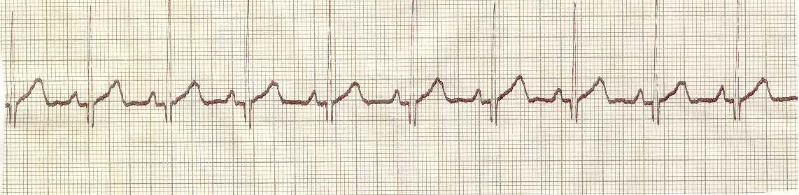 Sinusrytme Papirhastighet 25 mm/sek Rytme eksemplene Sinusrytme P-takkene kommer regelmessig og blir etterfulgt av et QRS-kompleks.