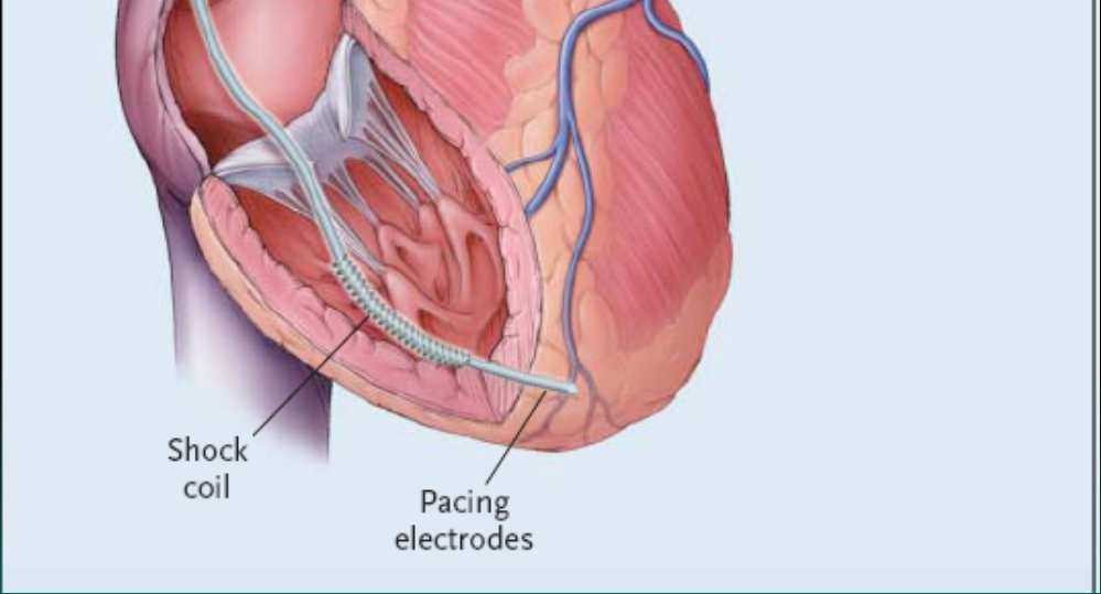 Implantable Cardioverter Defibrillators