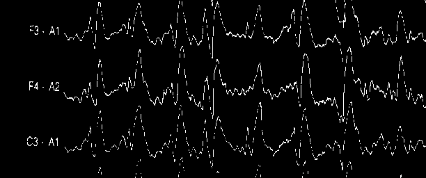 Komplekst partielt epilepsianfall: Start i ve. frontotemporal-region (elektrografisk anfallsaktivitet) Kramper Start. Utvikling.