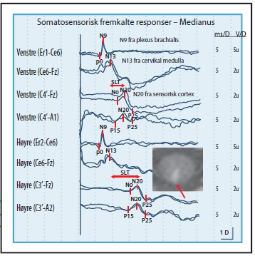 Somatosensorisk fremkalt respons (SEP) Måler funksjon i bakstrengsystemet Elektrisk stimulering: Medianus Tibialis Fig fra Sand et al TDNLF nr 9 2013 Fig fra Nevrologi