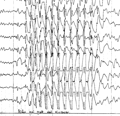 Epilepsi og EEG (2) Det er en sammenheng mellom type epileptiform aktivitet og epilepsisyndrom Fokal spike-aktivitet korrelerer med symptomer pasienter har under anfall: temporale spikes: