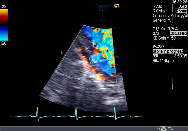 ramus interventricularis posterior (PDA = posterior decendig artery). Visualisering av høyre koronararterie PDA er lokalisert i den bakre interventrikulære fure.