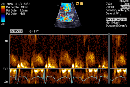 pasienten foreligger også en tydelig systolisk komponent. Måling av koronare blodstrømshastigheter Blodstrømshastigheter i koronararteriene måles med pulsetdoppler.