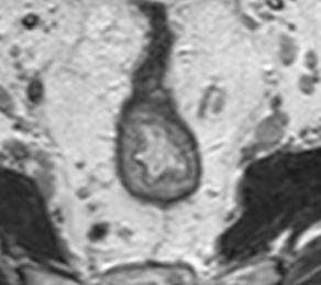 Lymfeknute metastaser mrt1 sm2n1 pt1sm2n2