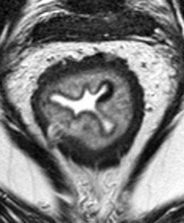 SRUS Solitary Rectal Ulcer Syndrome Kronisk inflammatorisk