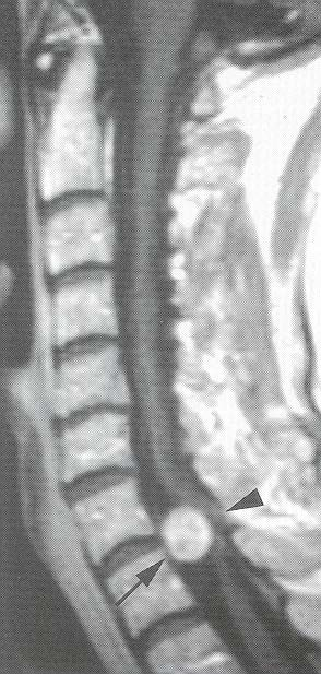 Differensialdiagnoser til ALS: - Cervical