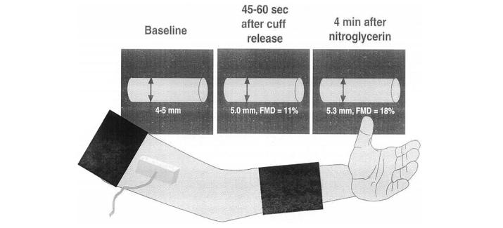 Figur 4. Plasseringen av mansjett og ultralydprobe ved måling av endotelfunksjon med FMD-metoden. A.brachialis måles over den anticubitale fossa i longitudinalplanet 28.