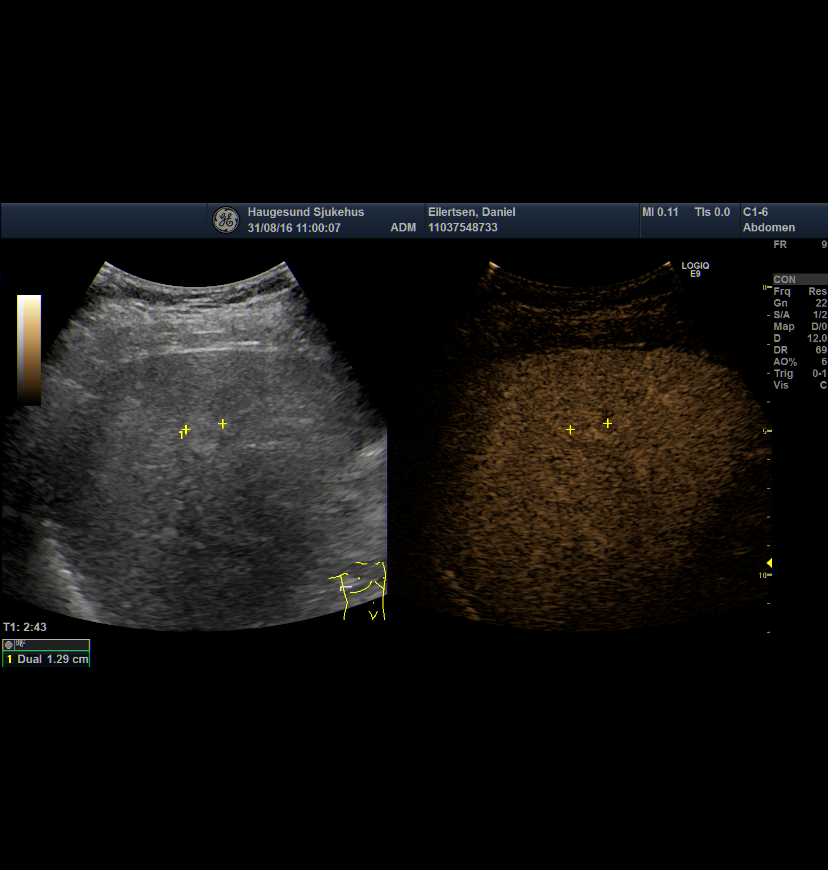 Contrast Enhanced UltraSound Indikasjoner, skille benigne fra maligne lesjoner. Spesielt nyttig når CT venøs fase ikke har svaret, ofte vanskelig å skille små cyster fra metastaser i leveren.