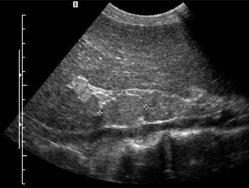 Intraduktalt innhold Kvinne med PSC f.1959 MRCP og MR lever mars 2013: Betydelig kaliberveksling, tydelig progresjon siden 2010 i venstre leverlapp. Levercirrhose.