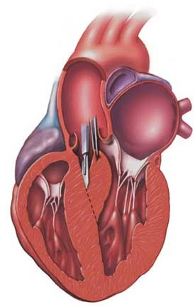 ACC/ESC expert consensus document, Maron and McKenna et al, JACC, 2003 Class IIa ESC Guidelines,