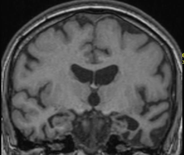 Figur 4.4.1 A) Frisk hjerne B) Atrofisk hjerne Figur 4.1.2 Atrofi av hippocampus Figur 4.1.3 Biparietal atrofi ved Posterior Scheltens skala grad 4 hos pasient med AD Kortikal Atrofi syndrom (Koedams skala 3) Figur 4.