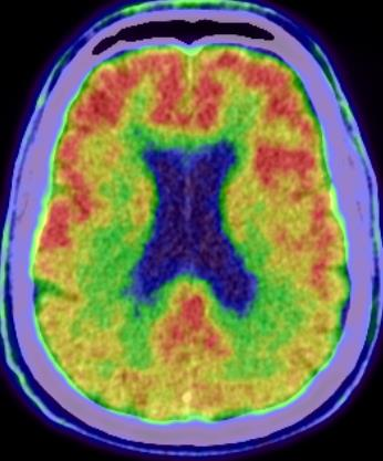 Figur 4.1.8 Normalt [ 18 F]FDG opptak (venstre) og nedsatt ved Alzheimers sykdom (høyre) Figur 4.1.9 FTLD; A) atferdsvariant ([ 18 F]FDG-PET), B) Semantisk Demens (SPECT) Figur 4.1.10 [ 18 F]FDG-PET ved Posterior kortical atrofi med klinisk bild av aperceptuelt visual agnosi Fig.