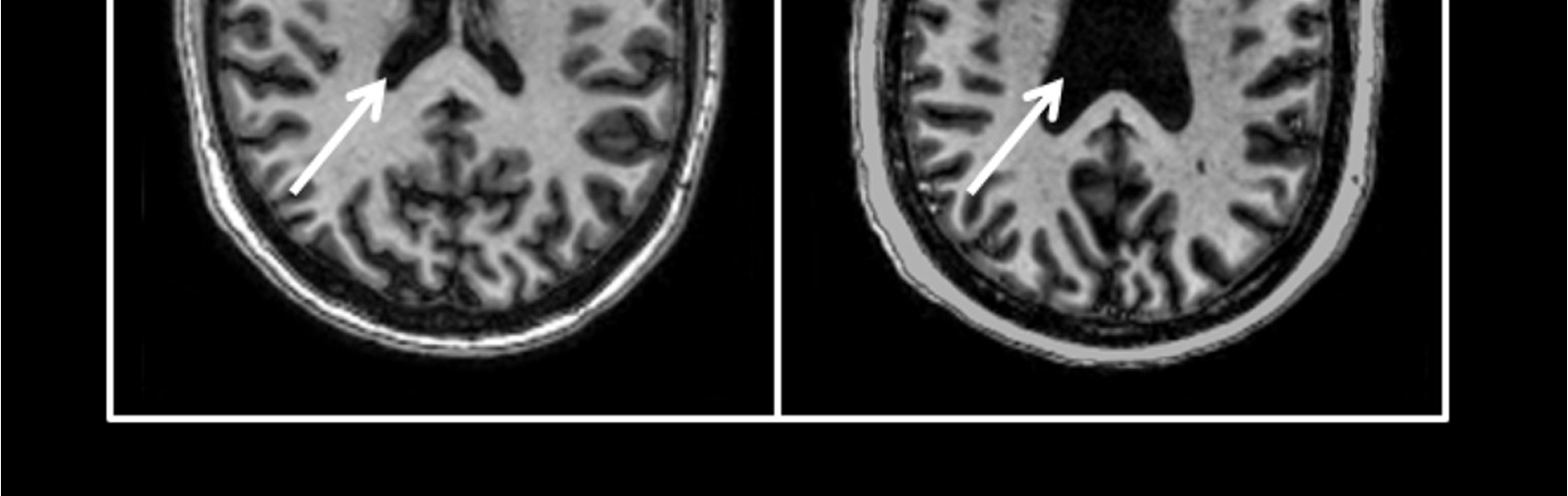 Representative example of lateral ventricle size in an ICU survivors with no preexisting cognitive impairment Gunther et al 2012 Poor mental health and functional