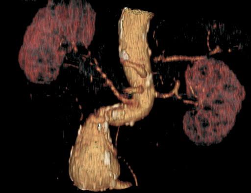 Kasus 1 2009 CT lumbalt aortaaneurisme Ca 80 år gammel mann med lumbalt aortaaneurisme.