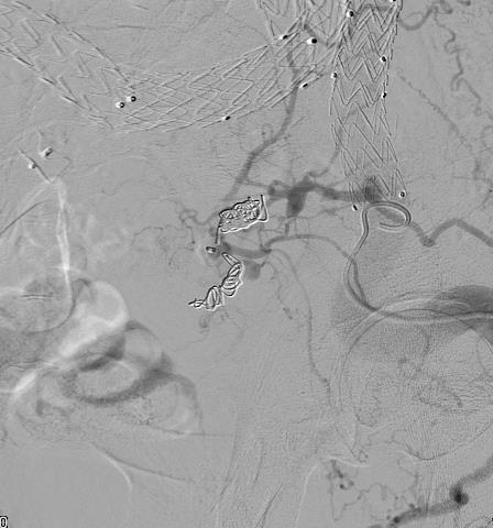 Kasus 2 Embolisering 3 år postoperativt Direkte gjennomlysningsveiledet punksjon transglutealt i bukleie.