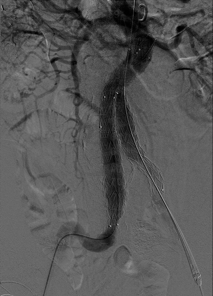 Kasus 1 Stentgraft ultimo 2009 Innsetting av stentgraft av typen Endurant forløp ukomplisert med unntak av litt