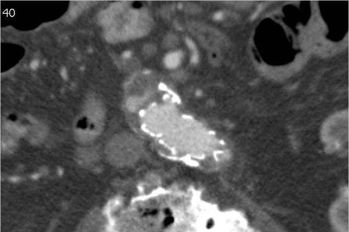 Kasus 1 CT kontroll 6 mndr. postoperativt Første kontroll viste uendret diameter av aneurismesekken.