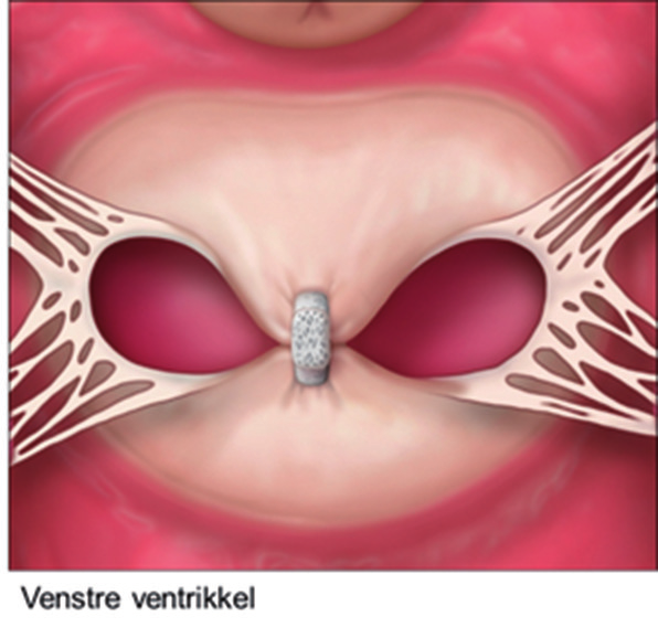 Resultatet vurderes i tillegg med 3D ekko for å fremstille dobbel klaffeåpning ( double-orifice ). Figur 6. Den trekkes tilbake og en fanger mitraklaffebladene før den lukkes.