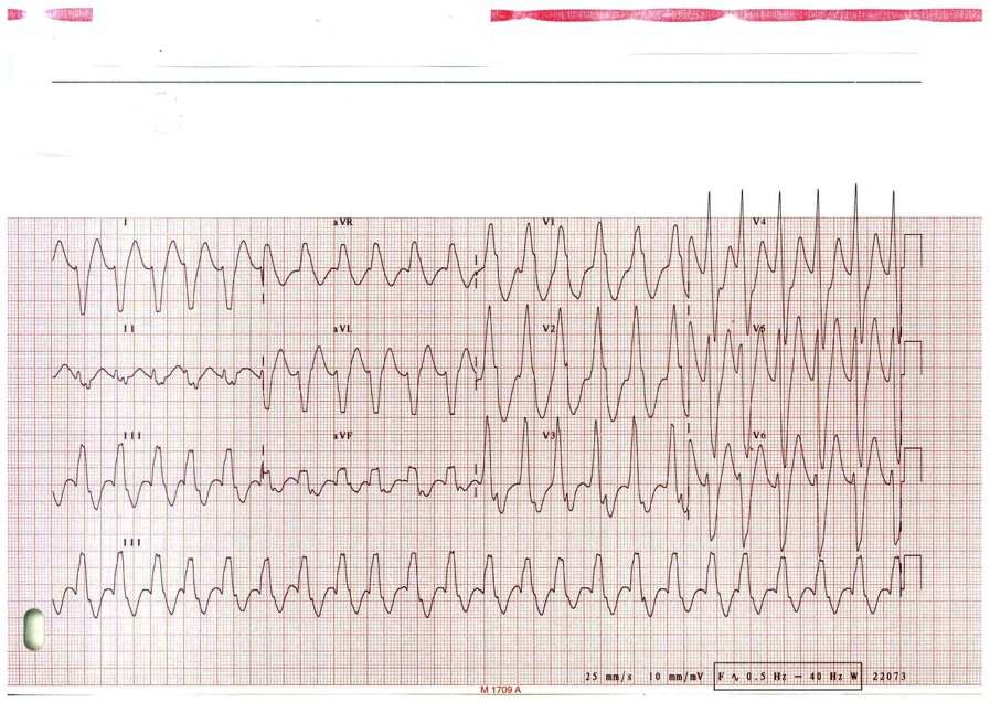 TAHICARDIE PAROXISTICA