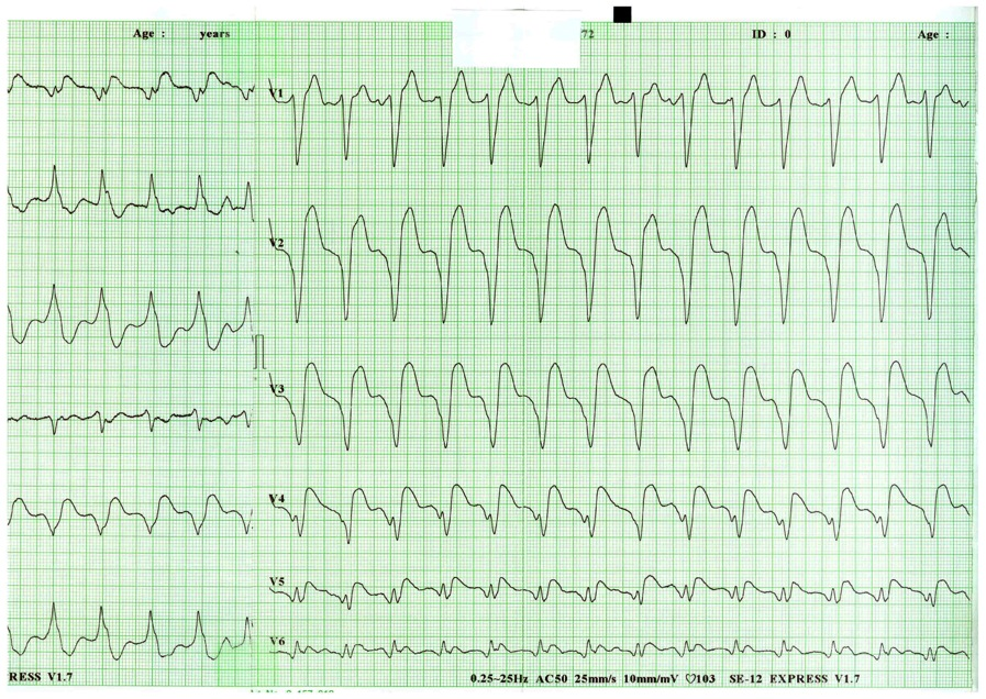 TAHICARDIE PAROXISTICA VENTRICULARA, LA UN PACIENT CU