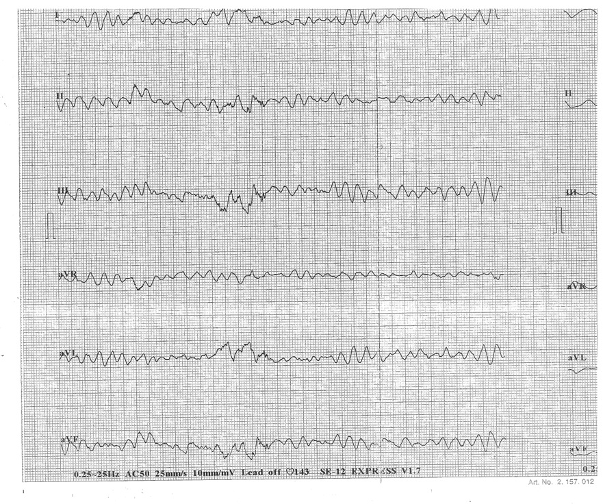 FIBRILATIA VENTRICULARA (fv): Nu exista complexe QRS. Activitatea electrica este reprezentata de oscilatii cu amplitudine, durata si frecventa variabile aperiodic (=haos).