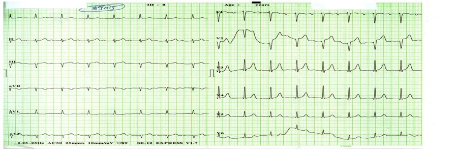 Fibrilatia ventriculara este o aritmie amenintatoare vital, o urgenta medicala maxima.