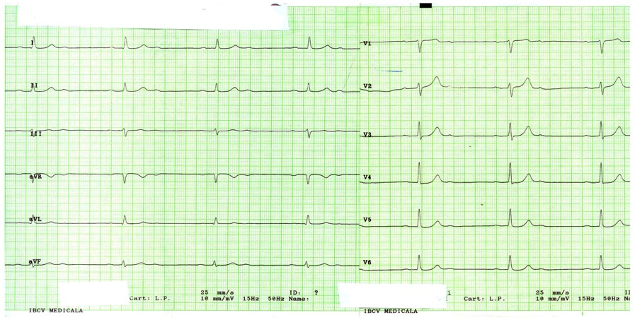 BLOC ATRIOVENTRICULAR DE GRADUL II, 2 / 1 BLOCUL ATRIOVENTRICULAR DE GRADUL III (BAV III=TOTAL=COMPLET) : Nu exista relatie intre activitatea electrica atriala si cea ventriculara (exista disociatie