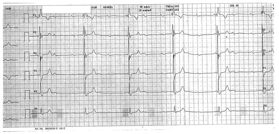 BLOC ATRIOVENTRICULAR DE GRADUL III HIPERTROFIA ATRIALA STANGA (HAS) : Durata undei P in cel putin una dintre derivatiile DII / DI / avl / avf > 0. 12 secunde si cu forma bifida («P Winternitz»).