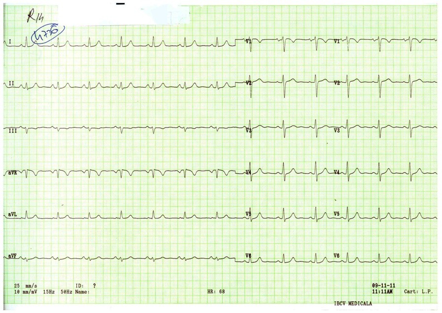 RITM SINUSAL BRADICARDIA SINUSALA (BS): Criteriul