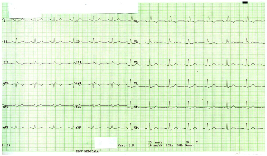 Ritm sinusal cu PR scurt (< 0. 12 secunde) ; 2. Durata QRS > 0. 12 secunde ; 3. Unda delta ; 4.