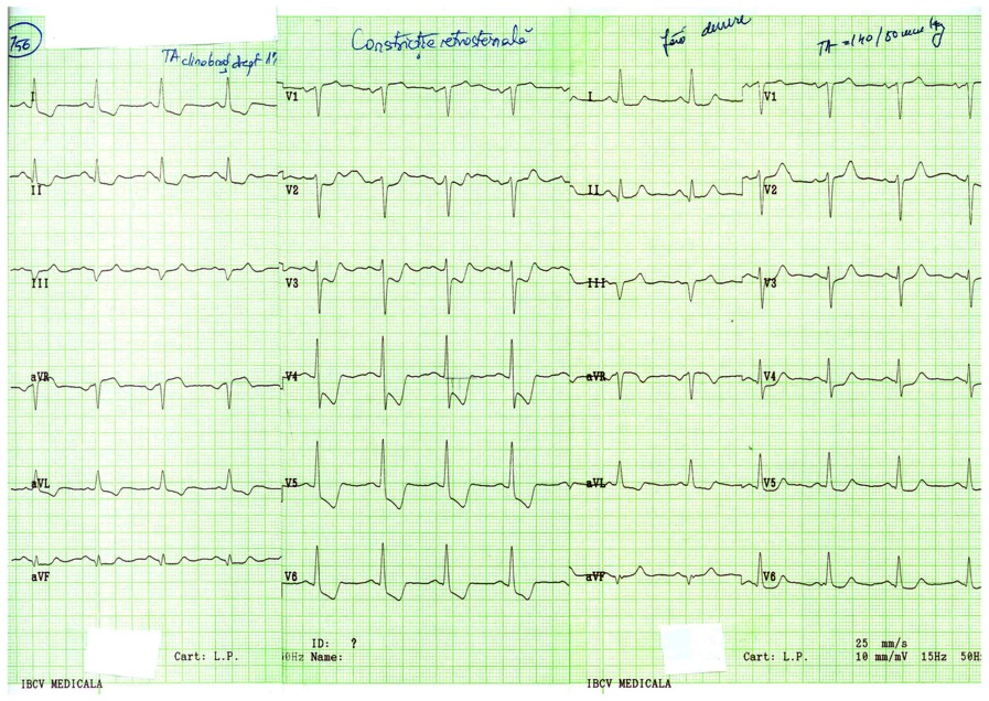 INFARCTUL MIOCARDIC : 1.