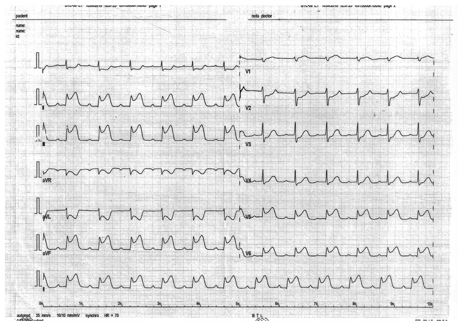 INFARCT MIOCARDIC INFERIOR SI