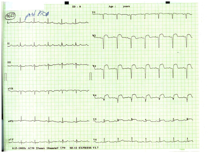 INFARCT MIOCARDIC ANTEROSEPTAL,