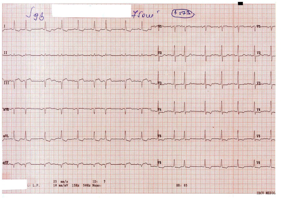 EXTRASISTOLA ATRIALA (ESA): Complex QRS prematur, cu morfologie similara, de obicei, cu morfologia restului complexelor QRS de origine sinusala, precedat de o unda P cu morfologie adeseori diferita