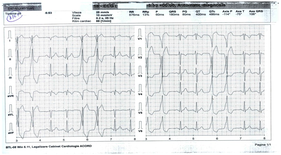 EXTRASISTOLE VENTRICULARE MONOMORFE, SISTEMATIZATE SUB FORMA DE CUPLETE FLUTTER UL ATRIAL (FA): Unde «F» atriale regulate, fara